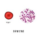 용혈빈혈[Hemolytic anemia]종양혈액질환 이미지