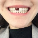 잠실치과 추천 강남치과 잠실새내 치과 앞니 라미네이트 잠실미백치료 잘하는 곳 수면치료