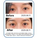 백피부과의원 | 왕십리피부과 애교필러 후기, 내게 맞는 디자인은?