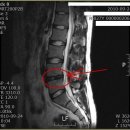 안녕하세요 MRI 사진과 증상입니다. 고견을 부탁드립니다. 이미지