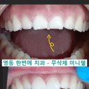 DM치과기공소 | [명동 한번에 치과] - 무삭제 미니쉘