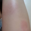 서은옥피부과 네이버블로그
