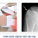 [석회화 건염 Calcific tendinitis _ 어깨재활 필라테스] _ 문정동필라테스 리업필라테스 이미지