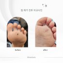 진주성형외과의원 | 결과, 2주간의 기록과 최종 진단. 진주 하얀메디컬의원, 유아 흑색종 의심 제거수술 조직검사 받은 후기2