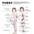 Cushing's syndrome 이미지