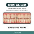 이진치과의원 | 양산 석산 치과 앞니 사이 레진 후기