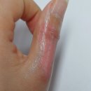 [심재성 2도 화상] 엄지손가락 자가치료 경과 후기 10개월차, 병원별 비교 및 연고 보관 꿀팁!