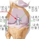 전방십자인대 손상 ( anterior cruciate ligament injury ) 이미지