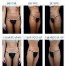 일공공성형외과의원 | [압구정 일공공성형외과] 복부 지흡 재수술 상담 사례 "배꼽 모양이 찌그러졌어요"