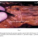 peroneus quartus muscle(accessory peroneus muscle)에 대하여 - 좀더 탐구해야 이미지