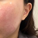 엄피부과의원 | 광주 더리프트의원에서 벨로테로 리바이브 스킨부스터 엄돈엄산 후기 리투오vs리바이브 차이 가격 비교