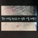 사과나무 토탈케어 | 목뒤 여드름 압출말고 원인잡는 케어로 GO!