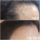 마곡 발산 헤어라인 문신 반영구 린브로우 후기