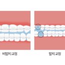 치아 교정 결정 시 사람들을 엄청 큰 고민에 빠트리는 것...jpg 이미지