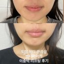투메이커 - 13768 | 대구피부관리 이중턱 고민 해결 I 두류역 뷰티메이커 이중턱 리프팅 후기