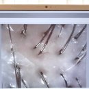 초이스안마 | 마곡두피관리 WT메소드 강서마곡점. 탈모, 지성두피 고민 상담 &amp; 민감성 두피 케어 후기.