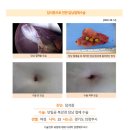 담석증수술후기. 수술 직후 2~3시간 경미한 통증, 배꼽 부위 땡김 외에 큰 통증은 없었습니다. 이미지