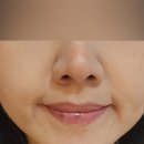 귀족 | 5살은 어려보이는 팔자주름 시술 리프팅 귀족침 후기