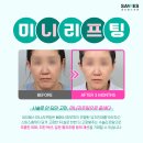 어반성형외과의원 | 턱라인리프팅, 미니리프팅가격 및 미니리프팅후기 정보