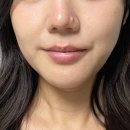 남구-12 | 울산 남구 피부과 덴서티하이 600샷 12일차 후기 기록