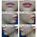 생강의료생활협동조합 돋움의원 | 영등포 쥬베룩과 쥬베룩볼륨으로 동안얼굴 만들기