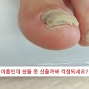 여름인데 샌들 못 신을까봐 걱정되세요?? #에이풋케어 #인천무좀발톱 #인천발톱무좀 #무좀발톱 #발톱무좀 이미지