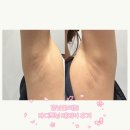참사랑한의원 | 강남 한의원 겨드랑이 + 무릎 바디토닝 레이저 후기