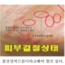 결절성 여드름의 특징 이미지