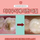 치아파절 원인 및 , 보험 (앞니 레진 어금니 크라운 깨짐) 이미지