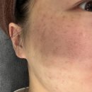 지움의원 | 창원 피부관리 :) 기미 주근깨 색소 지움 패키지 (내돈내산)