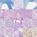 Re: 뇌혈관 병변이 multiple system atrophy를 일으키기도 한다는 논문.. 이미지