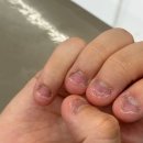 손톱이야기 | 강남 대치동 네일은청담 물어뜯는 손톱 발톱 후기