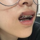안면비대칭 교정기 15개월 후기, 턱관절까지 좋아졌어!