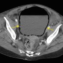 Emphysematous cystitis 이미지