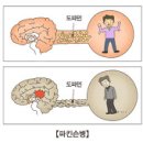 고(엉덩이,넓적다리 股) 관절 통증(질환, 관척센=정형외과 OS), Parkinson`S Disease, 2차 합병증, 뇌정맥 혈전증, 혈전용해제 이미지