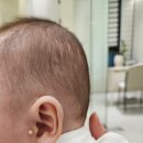 원케어텍 | [우당탕탕 육아일기] 142일차 아기 신생아 스킨텍 제거 수술