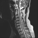 제 경추 mri 진단좀 이미지