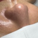 서면교차로 | 서면 모공 관리 오비아 에스테틱 블랙헤드 관리 후기