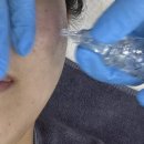 나이스메디칼 | 청주 가경동 피부관리 잘하는곳 추천 <누예뷰티> 모공관리 프락셔널플라즈마 핫플라즈마 관리후기