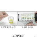 소변내 과도한 단백질 단백뇨 이미지