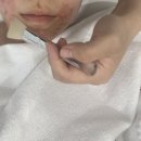 하이필스킨 | 여의도 여드름관리 하이필스킨 트러블피부케어 후기