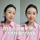 멍블링 | 줄기세포 피부주사 강남 피부과에서 받은 후기 공유해요