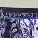 강남성심한의원 | 2025. 7. 8. 화. 경추 후종인대골화증 &amp; 흉추 황색인대골화증으로 입원 in 강남 세브란스병원