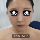 신림피부샵 하얀스킨앤바디 신림점 리프팅 관리 후기