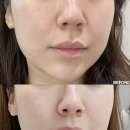 (주)텐이얼즈애프터 | 강남역 피부과 고현정리프팅 텐써마 300샷 후기