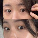 멍, 타임 | 발산피부과 눈밑지방재배치 한달 후기 (멍, 붓기, 2개월 경과)