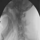 Lt ICA 85% stenosis = filter - balloon - stent 이미지
