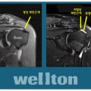 어깨 회전근개파열 이미지