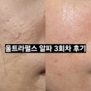 알파약국 | 강남 울트라펄스 알파 여드름패인흉터 치료 3회차 효과 후기 (일주일 경과, 관리방법, 전후비교)