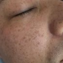 판암반점 | 대전동구피부 대전흑자 뷰마르 대전판암점 플라즈마 흑자관리 후기